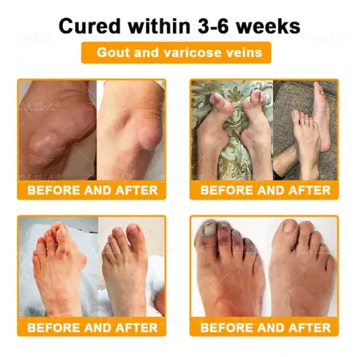ZVLZVL® Bee Venom Pain-Relief Bone Healing Cream