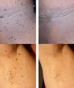 Nurbini® Non-Invasive Mole & Wart Pen