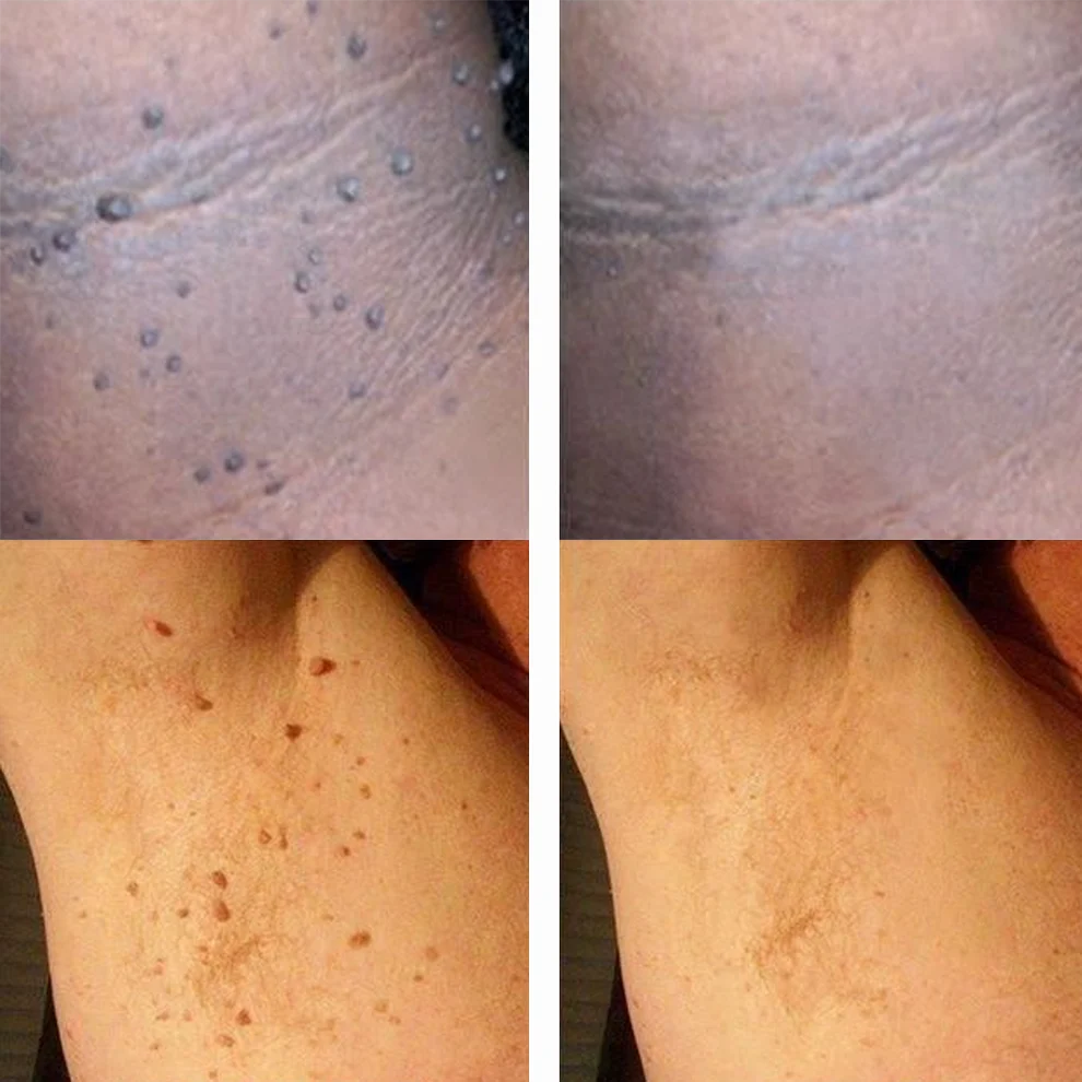 Nurbini® Non-Invasive Mole & Wart Pen